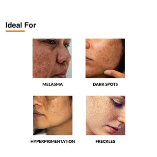 2_Kojic_Acid_1_Arbutin_Skarfix-Plus_Scar_Removal_Cream_Hyperpigmentation_and_Melasma_Treatment_SilkRoutes_3