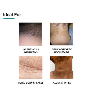 FixdermaNigrifixCreamForAcanthosisNigricansForDarkNeck_Ankles_Knuckles_Elbows_SilkRoutes_5