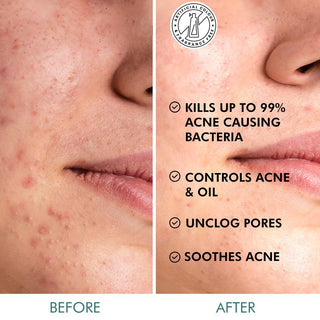 MCaffeine 2% Salicylic Acid Serum Clear Skin Acne Pads | Acne & Oil Control with Matcha Tea - 40 N (x1)_SilkRoutes_5