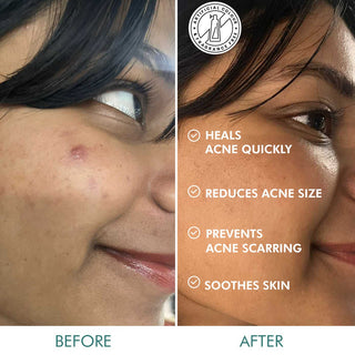 MCaffeine Matcha Tea Hydrocolloid Acne Patches with 0.5% Salicylic Acid | Reduces Acne in 2 Uses - 3 Sizes (24N)_SilkRoutes_4